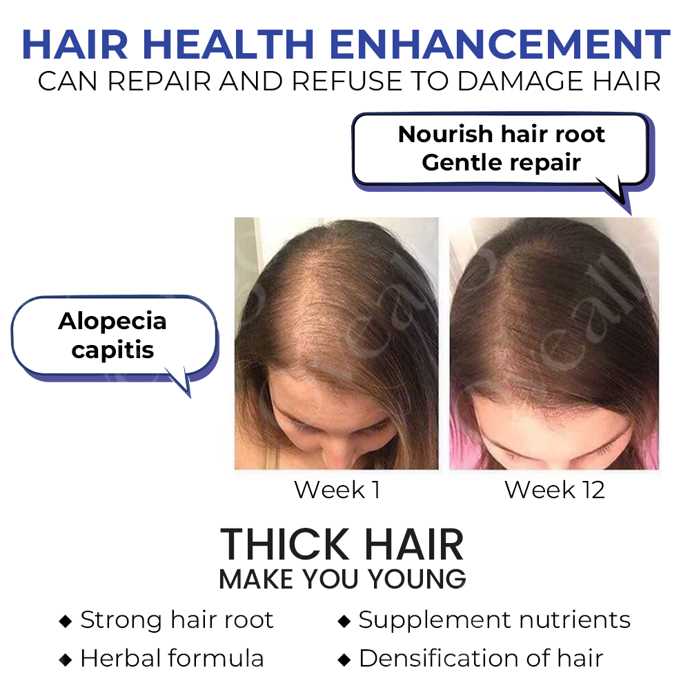 đ„ HOT SALE: 60% OFFđ„CvreozÂź ReVita Hair Growth Serum - Minoxidil Topical Solution USP, 5% with Biotin