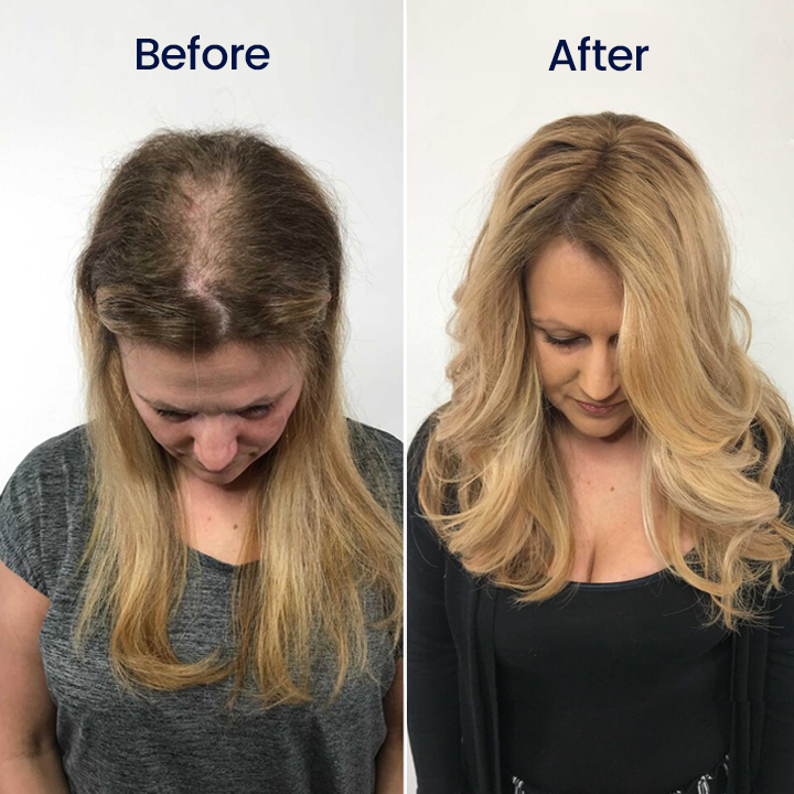 Limited Time Offer – 60% OFF Today Only! Cvreoz® Minoxidil Fast-Action Hair Growth Serum