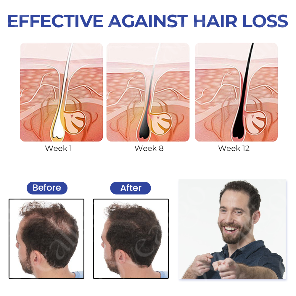 đ„ HOT SALE: 60% OFFđ„CvreozÂź ReVita Hair Growth Serum - Minoxidil Topical Solution USP, 5% with Biotin