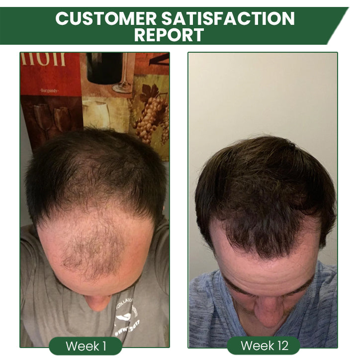 ⏰Last Day Promotion: 60% OFF🔥 Cvreoz® Shouga Essence Hair Growth Oil