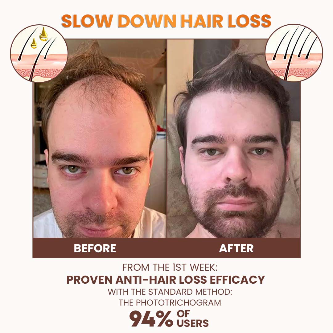 LIMITED TIME SALE OFF 60%🔥Cvreoz® Premium Biotin Hair&Beard Booster