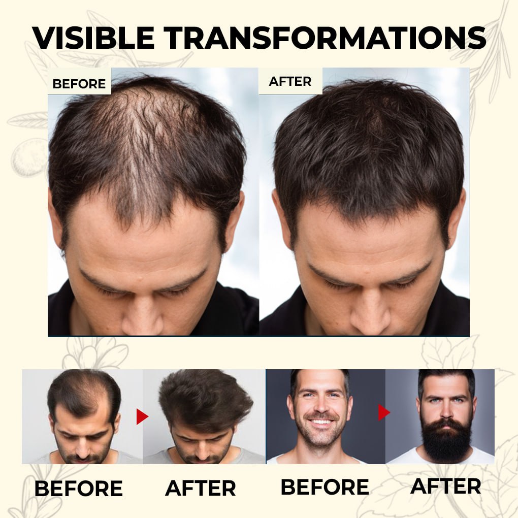 đ„60% OFF TODAY ONLYđ„CvreozÂź Natural Hair Growth Spray